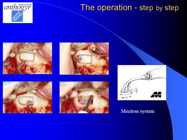 [/userfiles/files/Bone-Implantation-13.jpg]