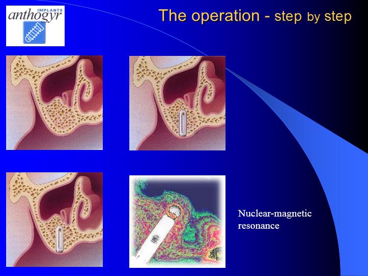 [/userfiles/files/Bone-Implantation-14.jpg]