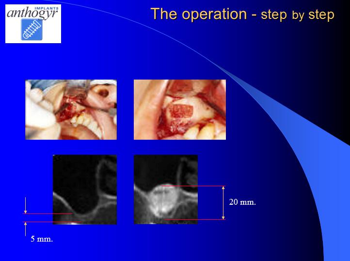 [/userfiles/files/Bone-Implantation-15.jpg]