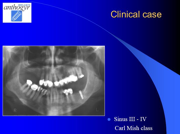 [/userfiles/files/Bone-Implantation-16.jpg]