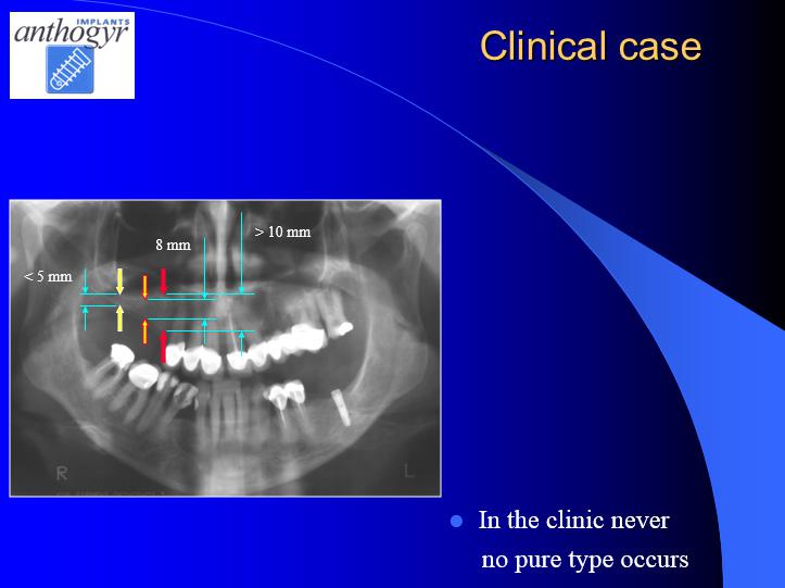 [/userfiles/files/Bone-Implantation-17.jpg]