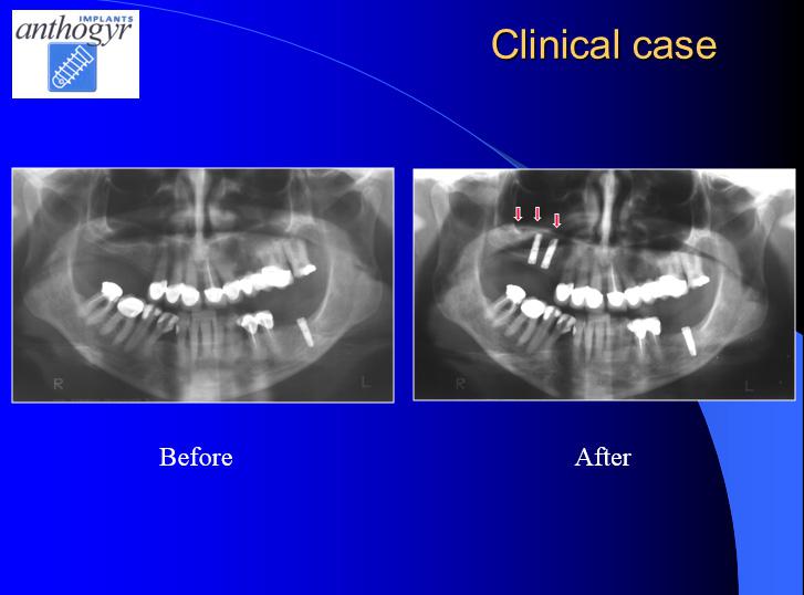 [/userfiles/files/Bone-Implantation-18.jpg]