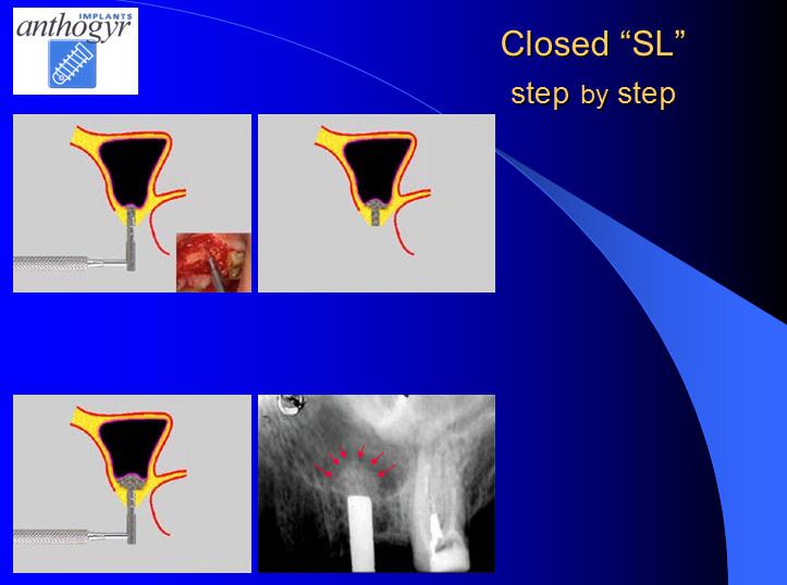 [/userfiles/files/Bone-Implantation-5.jpg]