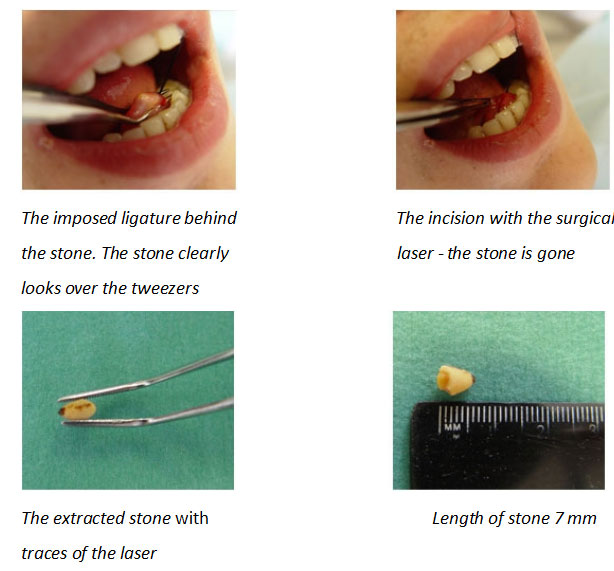 [/userfiles/files/Salivary-stone-disease.jpg]