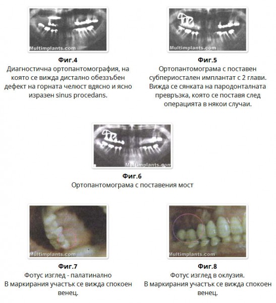 [/userfiles/files/subper-implant-4-5-6-7-8.jpg]